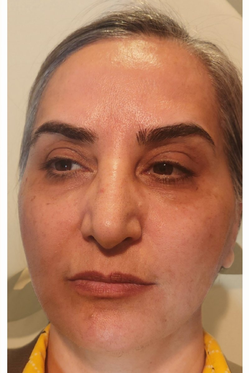 After image