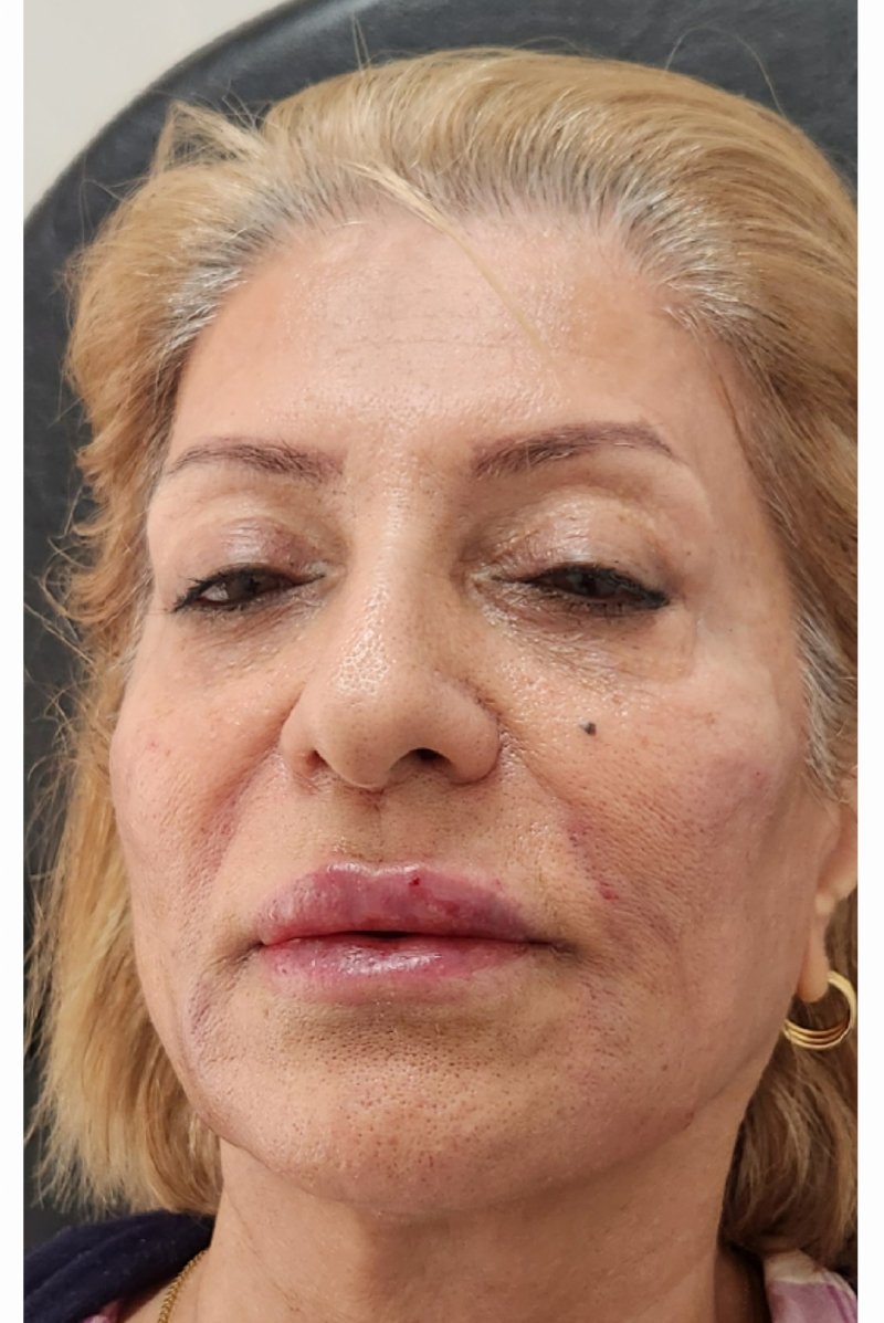 After image